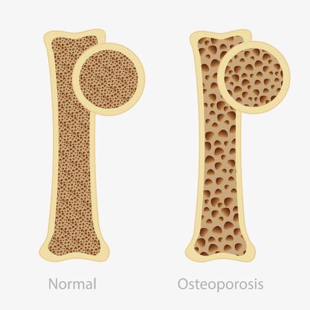 Cartoon human osteoporosis and normal healthy bone vector flat illustrationのイラスト素材