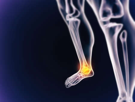 When inflammation strikes. A cgi view of an inflamed joint isolated on blue.の写真素材