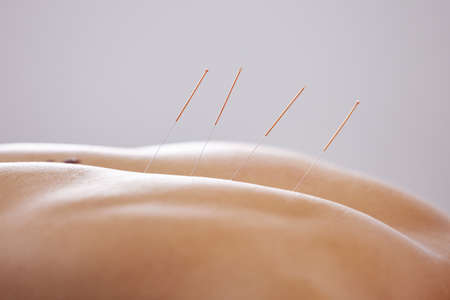 I shouldve tried acupuncture sooner. a man using acupuncture needles.の写真素材