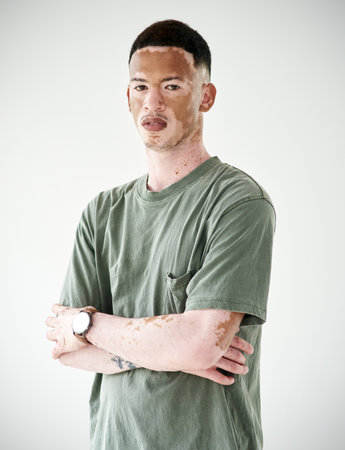 You are perfect exactly as you are. Studio portrait of a young man with vitiligo posing against a...