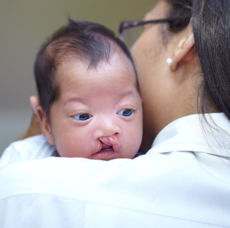 A shoulder to cry on. a baby girl who has a cleft palate looking over the shoulder of her mother.の写真素材