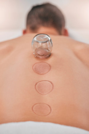 Wellness, man and cupping massage at spa for relief in stress, inflammation and back pain, healthcare and relax. Cupping therapy, back and guy in resort for alternative therapy, acupuncture and restの写真素材