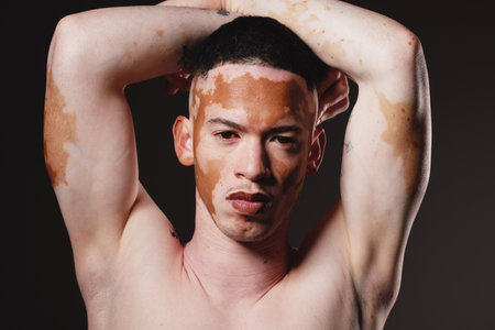 Skincare, beauty and portrait of man with vitiligo on black background for wellness, dermatology and body care. Fashion, cosmetics and face of male with natural, healthy and glowing skin in studioの写真素材