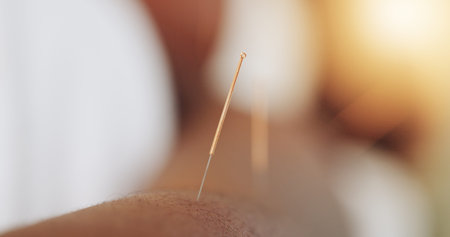 Acupuncture, needles and skin for wellness in clinic, alternative medicine or healing therapy....