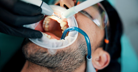 Hands, man or mouth cleaning in dental clinic for tooth procedure, veneers and medical surgery. Appointment, operation or patient in oral exam for dentistry, teeth whitening and cosmetics treatmentの写真素材