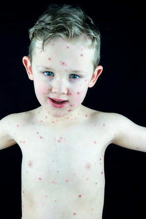 Caucasian boy with chickenpox infection, rash and blisters. Portrait studio shot with black background.の写真素材