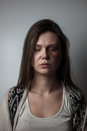 Domestic violence, abuse woman with bruise on face