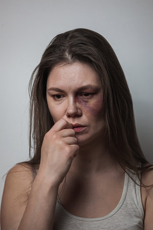 Domestic violence, abuse woman with bruise on face