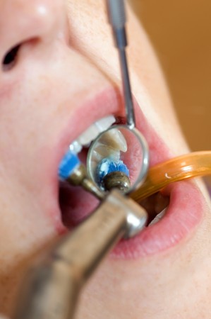 At the dentist - teeth whitening