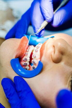 Female patient at dental procedure using dental drill in modern dental clinicの写真素材