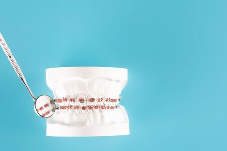 Dental braces model on blue background.の写真素材