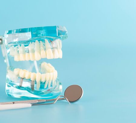 Dental implant model on blue background.