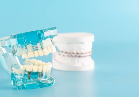 Dental implant model on blue background.の写真素材