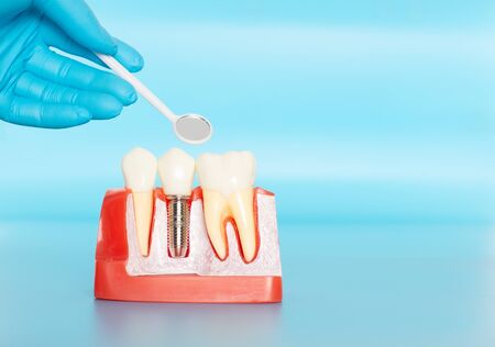 Plastic samples of dental implants compare with natural teeth for patients acknowledged the differences Of both types of teeth. To make decisions before beginning dental implant treatment.の写真素材