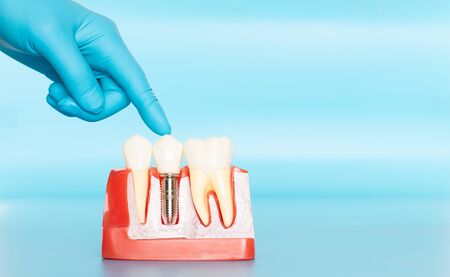 Plastic samples of dental implants compare with natural teeth for patients acknowledged the...