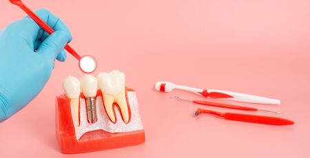 Examples of dental implants made from silicone demonstrate components of dental implants. When inserted into the patient's gums for the patient to understand before starting treatment.の写真素材