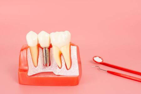 Examples of dental implants made from silicone demonstrate components of dental implants. When inserted into the patient's gums for the patient to understand before starting treatment.の写真素材