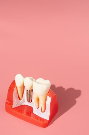 Examples of dental implants made from silicone demonstrate components of dental implants. When inserted into the patient's gums for the patient to understand before starting treatment.の写真素材