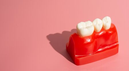 Examples of dental implants made from silicone demonstrate components of dental implants. When inserted into the patient's gums for the patient to understand before starting treatment.の写真素材
