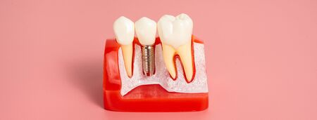 Examples of dental implants made from silicone demonstrate components of dental implants. When inserted into the patient's gums for the patient to understand before starting treatment.の写真素材