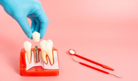 Examples of dental implants made from silicone demonstrate components of dental implants. When inserted into the patient's gums for the patient to understand before starting treatment.の写真素材