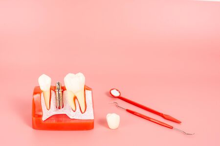 Examples of dental implants made from silicone demonstrate components of dental implants. When inserted into the patient's gums for the patient to understand before starting treatment.の写真素材