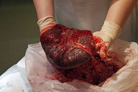 a nurse shows what a placenta looks like, sometimes called the tree of lifeの写真素材