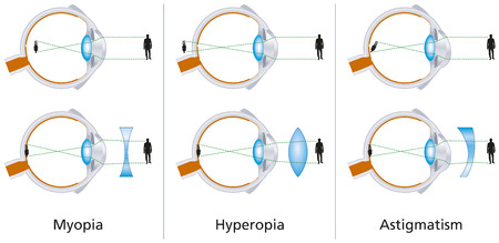 Visual Defects - Myopia, Hyperopia And Astigmatismのイラスト素材