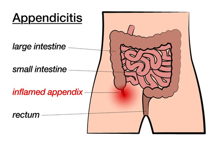 Appendicitis. Inflamed appendix. Labeled chart with large and small intestine, appendix and rectum. Isolated vector on white background.のイラスト素材