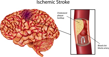 Brain Stroke . A illustration of Ischemic Stroke. のイラスト素材