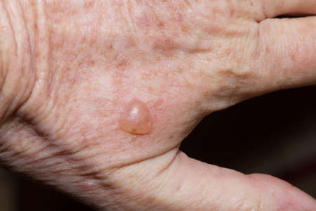 Raised blister from cryotherapy for solar keratosis on hand of 65 year old caucasian man
