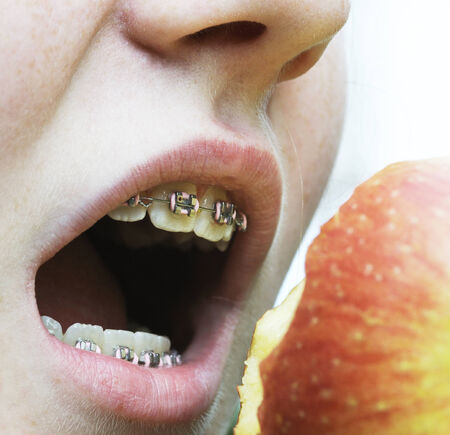 Young girl with dental brace eating an apple