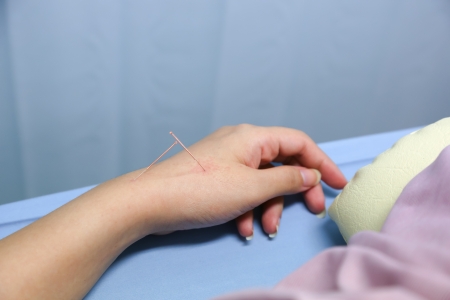 Hand of a woman with acupuncture treatmentの写真素材