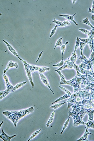 Microscope view of mens health Prostate Cancer cells in tissue culture showing walls, nucleus and...