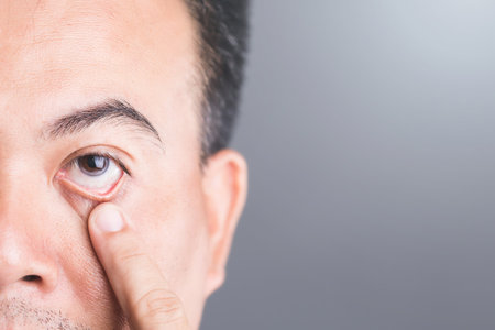 Close-up of a diabetic patient's eye, symbolizing the risks of diabetic retinopathy and macular degeneration. Emphasizes the importance of eye health and monitoring for diabetes-related complicationsの写真素材