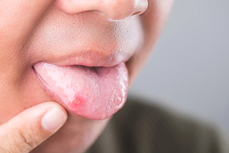 Close-up of a patient's mouth showing an oral ulcer on the tip of the tongue, highlighting the discomfort and common symptoms of mouth soresの写真素材