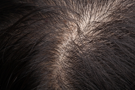Closeup head with thinning hair and scalpの写真素材