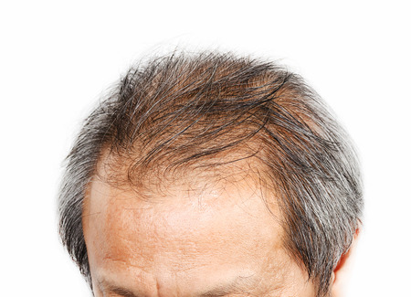 Male head with hair loss symptoms front sideの写真素材