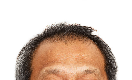 Hair loss , Male head with hair loss symptoms .の写真素材