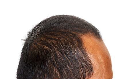 Hair loss , Male head with hair loss , isolated on white background.の写真素材