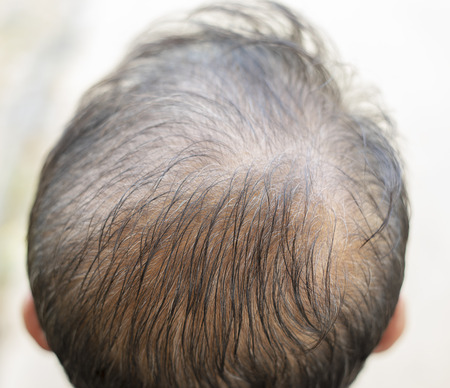 Hair loss top view of asia man.の写真素材