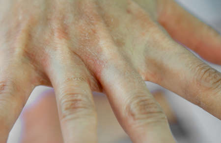 Women's hands that are dry because of allergies to chemicals, detergents, and hand sanitizerの写真素材