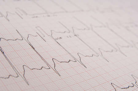 A medical printout from an ecg machine measuring activityの写真素材