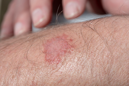 eczema on the arm of a man, close up