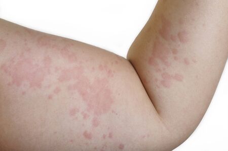Allergy rash caused by allergyの写真素材