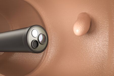 Colonoscopy technology concept with 3d rendering endoscope inside of intestine with polyp