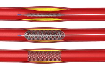 3d rendering balloon angioplasty procedure with stent in vein isolated on whiteの写真素材