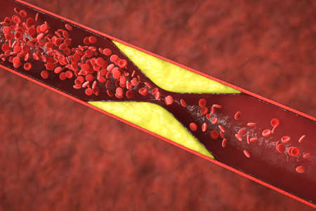 3d rendering atherosclerosis with cholesterol blood or plaque in vessel cause of coronary artery...