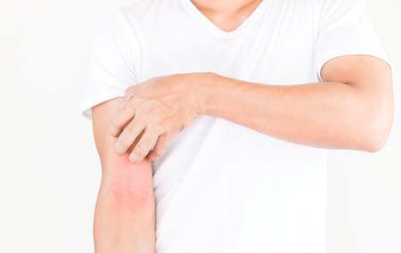 Young men scratch the itch on arm surface, Healthcare concept.