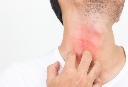 Young man scratch the itch on him neck, Healthcare concept.
